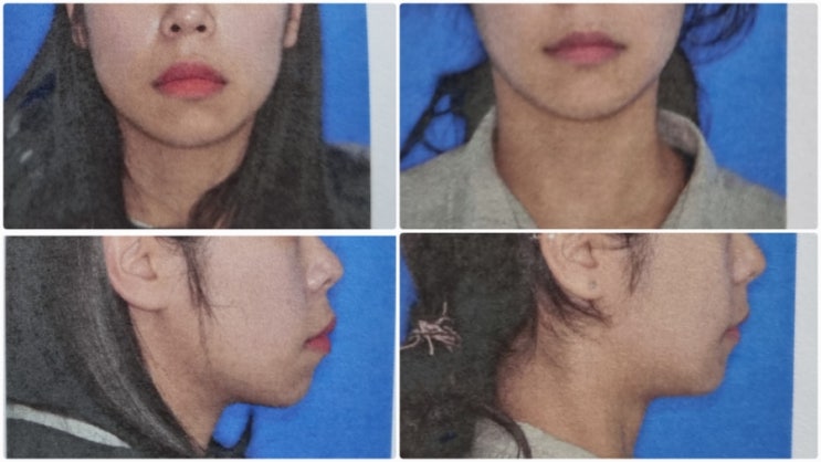  (광고 아니고 내얼굴..)돌출입 교정 후기로 알아보는 돌출입교정비용/기간 어떻게 될까?
