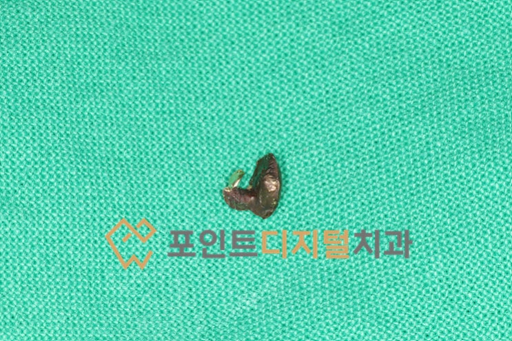  [탕정치과]  인레이 탈락부위 크라운이나 인레이 대신 레진으로 마무리한 케이스 / 천안 아산