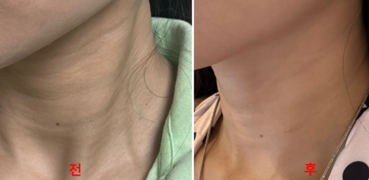  신사역 피부과 목주름필러 후기 비용 통증 정리