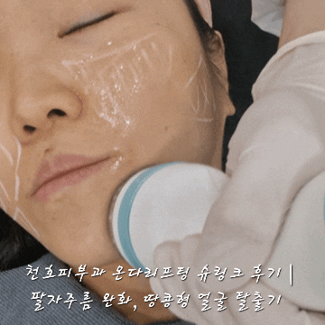  천호피부과 온다리프팅 슈링크 후기 | 팔자주름, 땅콩형 얼굴 탈출기