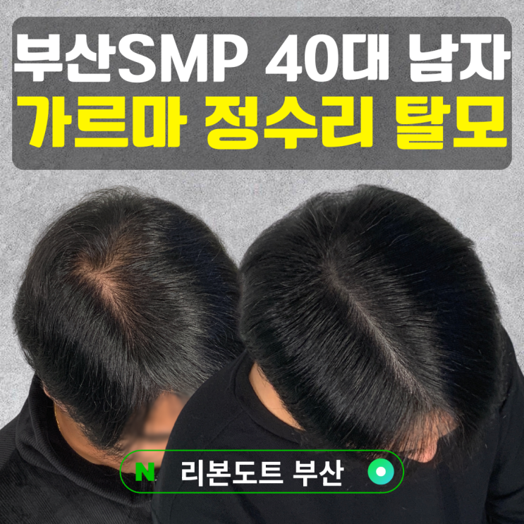  부산SMP 40대 남자 탈모, 가르마와 정수리 비침 4주 커버 과정 (실제 후기)