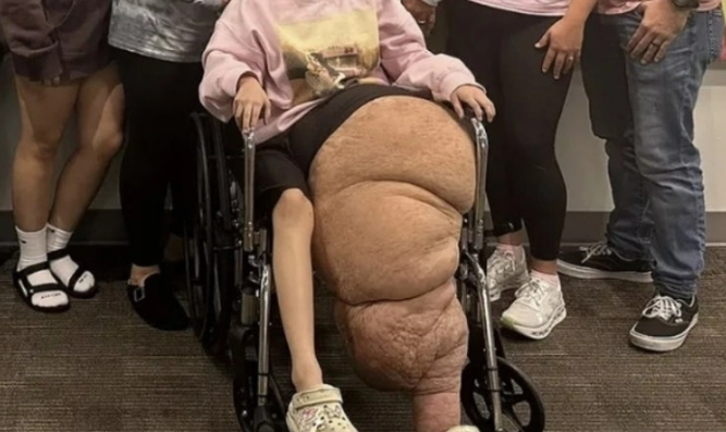  한쪽 다리만 79kg까지 자라난 美 소녀의 눈물겨운 사투와 새로운 희망
