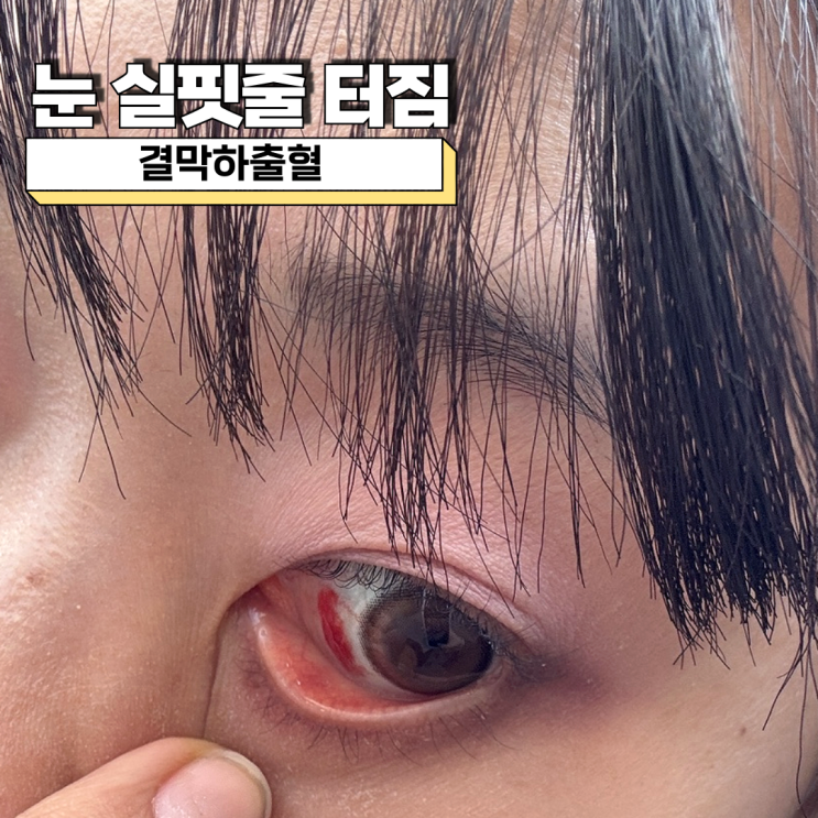  눈 실핏줄 터짐 왜 생길까? 결막하출혈 증상과 회복 과정
