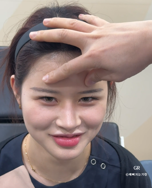 눈꺼풀 처짐 심할 때 진짜 원인을 파악하는 방법