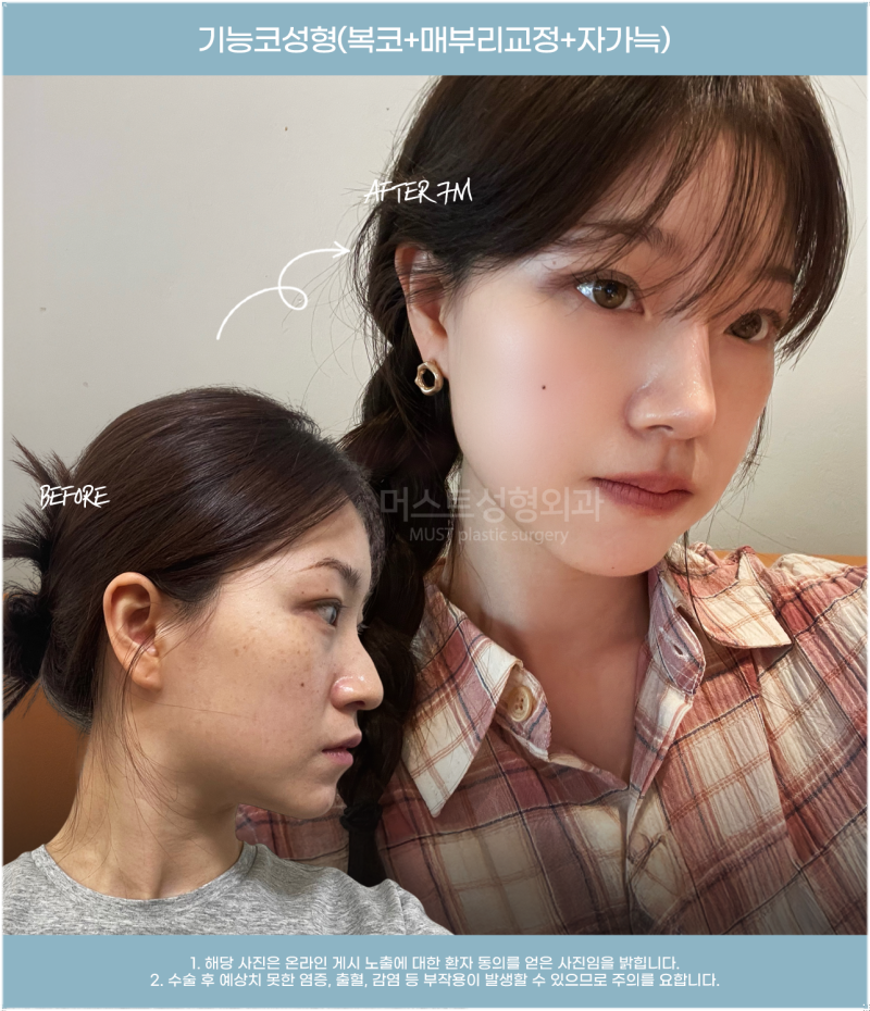 기능코성형 보험 이건 확인하세요