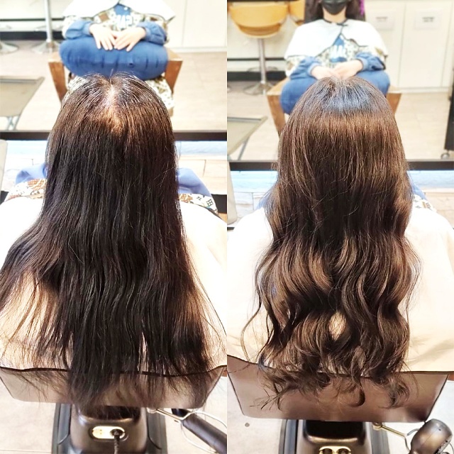  아산 가르마 갈라짐 고민, 원형 탈모처럼 휑한 가마도 링거펌 모류교정으로 지워질까요?