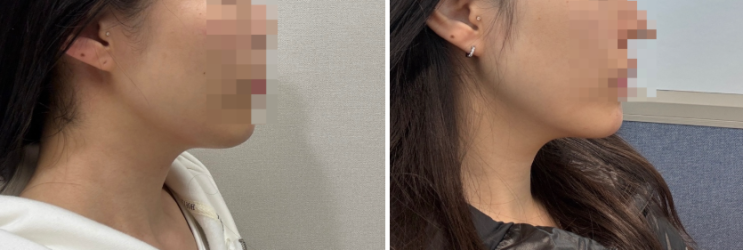  온다리프팅 2번째 7일차 후기 압구정피부과 턱선 리프팅 효과 솔직리뷰