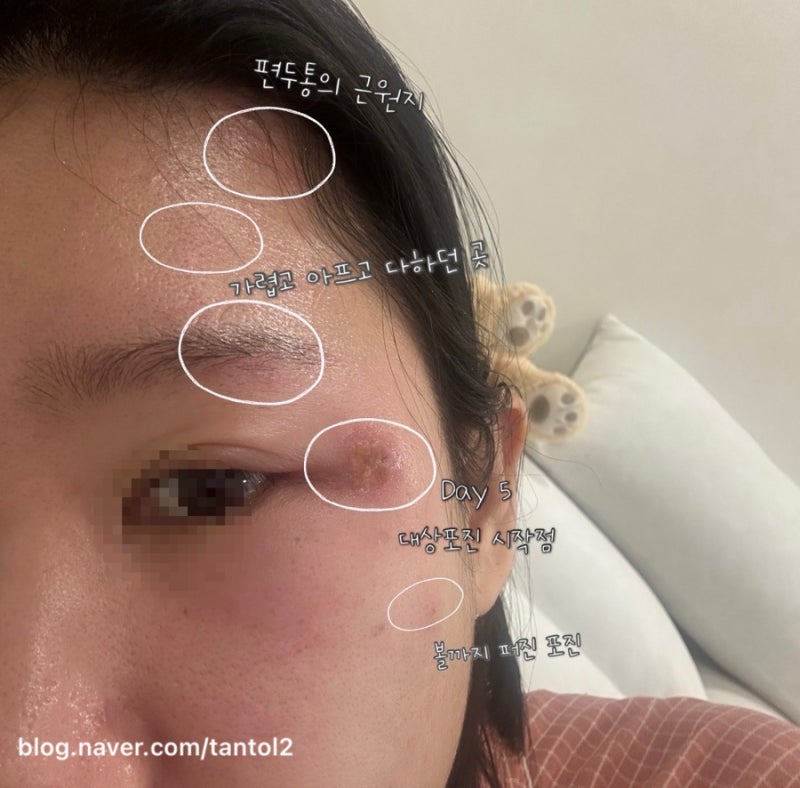 얼굴 대상포진 3탄: 절망의 5일차, 은평구 피부과 치료 리얼 후기(신경통, 회복)