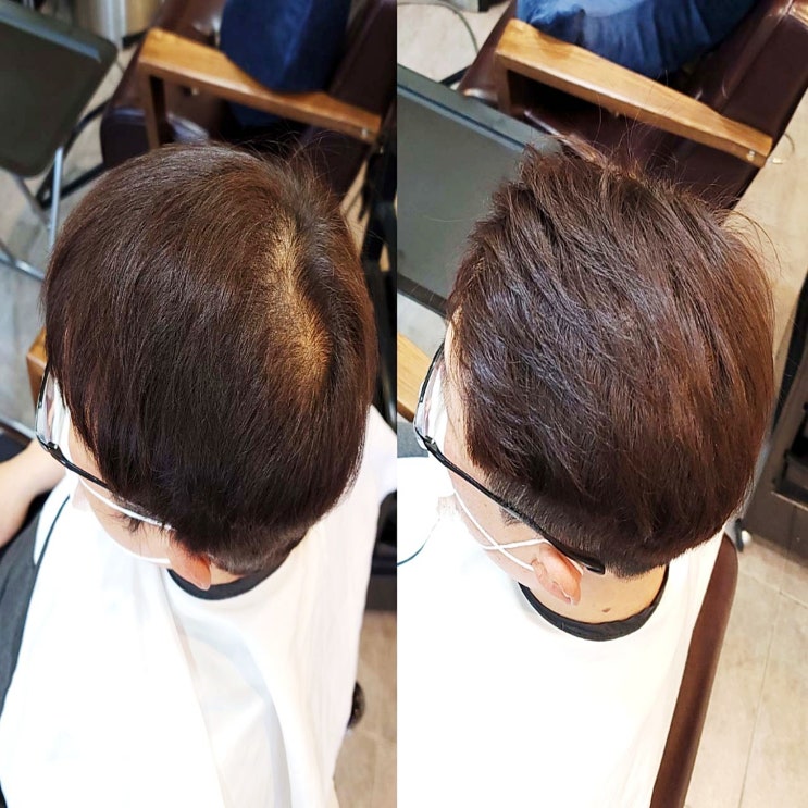  안산에서 수원까지 찾아온 이유? 40대 남성 정수리 탈모 고민, 링거펌 모류교정으로 지워질까요?