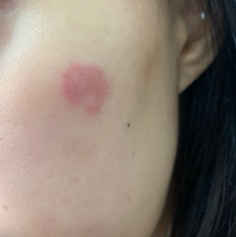 내돈내산 대구 지연성 알러지 검사 IgG4 음식물 과민증 검사 후기 | 대구 병원 알레르기 검사 ....