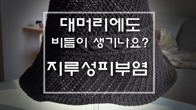  대머리에도 비듬이 생기나요? 지루성피부염 두피 관리 3가지