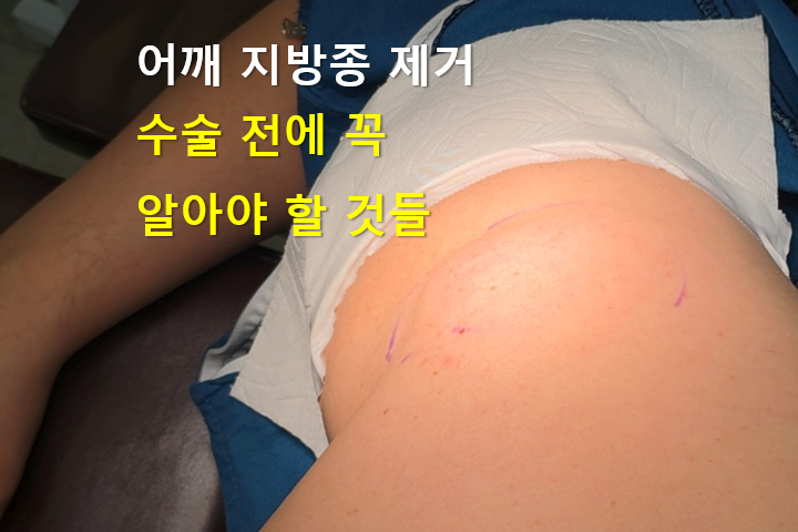 어깨 지방종 제거 수술 필요한 경우를 알아보자