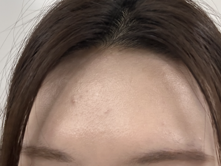  갑자기 올라온 이마 뾰루지,원인부터 해결법까지완벽 정리!