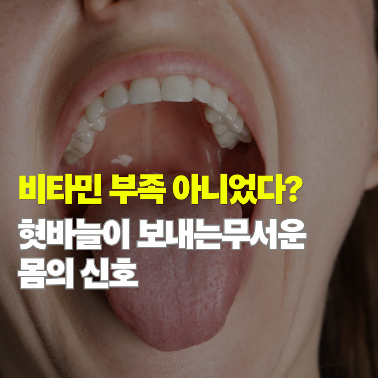  혓바늘 원인 5가지, 비타민 부족인 줄 알았는데 '이것' 때문이라면?