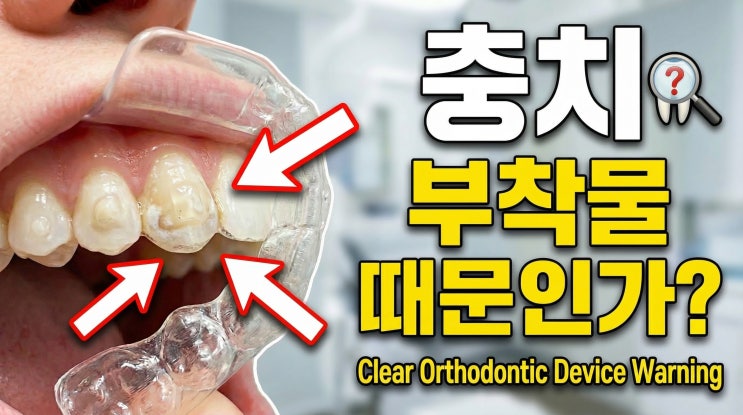  치아 투명교정 치료시 부착물(attachment)의 처리가 세균 번식에 미치는 영향! 투명교정도 충치가 잘 생길까?