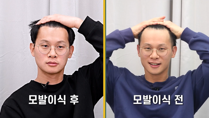 터키 모발이식 지금이 가장 저렴할 때! 비절개 터키모발이식 7,500모 후기 공개