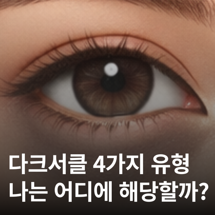  다크서클, 유형별로 원인이 완전히 다릅니다
