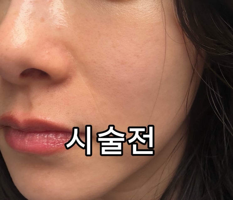  [내돈내산] 토닝+비타민C 관리 & 글루타치온 600 수액 솔직 후기 (통증/다운타임)