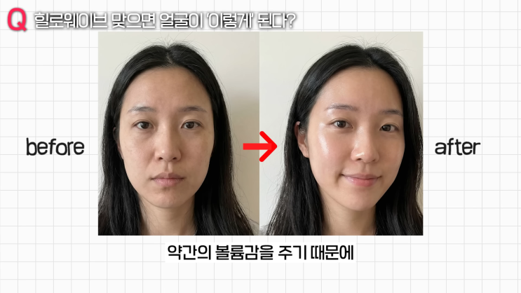  여의도 힐로웨이브 피부과 고르는 기준 3가지