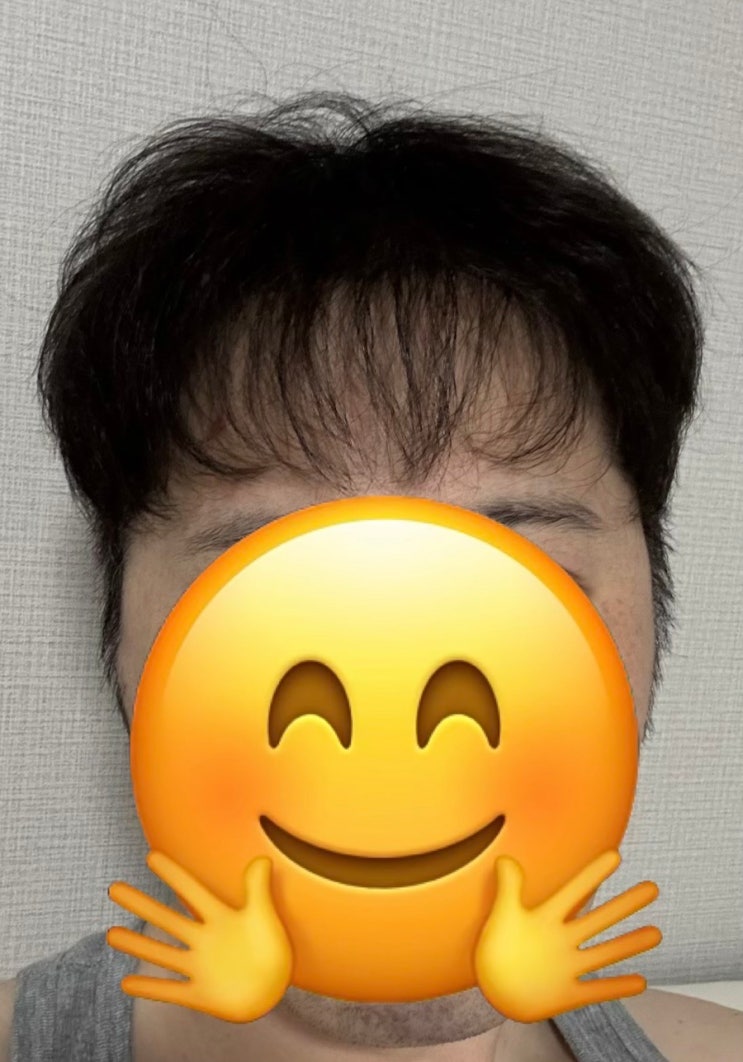  터키 모발이식 딱 1년 된 후기