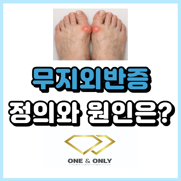 무지외반증이란? 원인과 정의 정리해 드릴게요.
