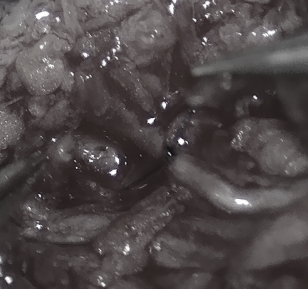 손가락 압궤손상 (압착손상) 치료 후 발생한 손끝 통증 치료방법: 제2족지 수질 유리피판술 2nd toe pulp free ...