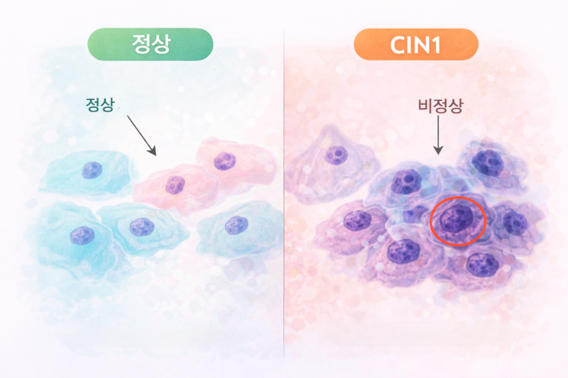 CIN1은 치료해야 할까요?
