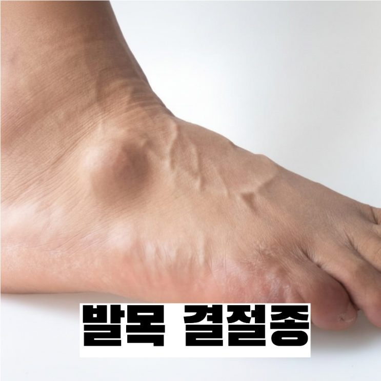  발등·발목에 혹이 생겼어요 결절종 비수술 치료는?