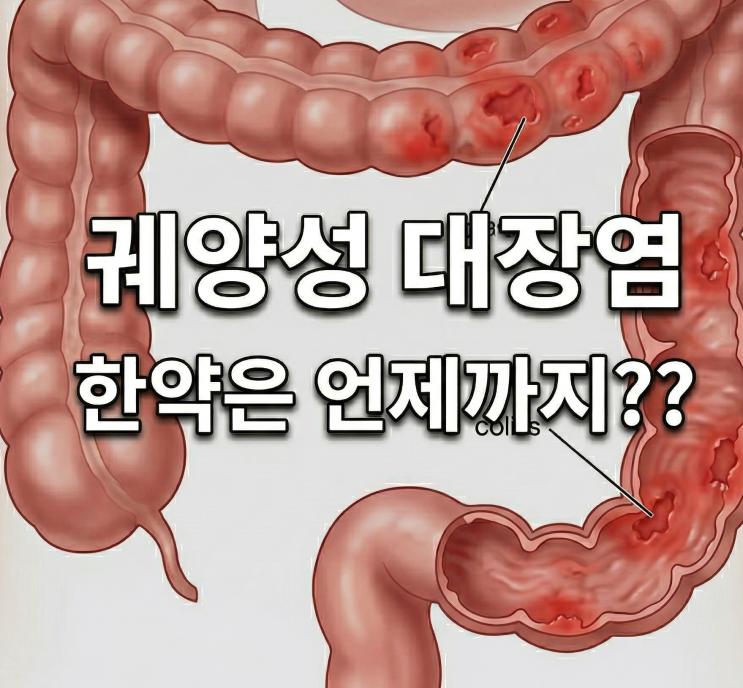  궤양성 대장염 환자들에게 사용한 한약은 과연 효과가 있었을까? 관해가 되었을 때 한약은 언제까지 사용해야 할까?