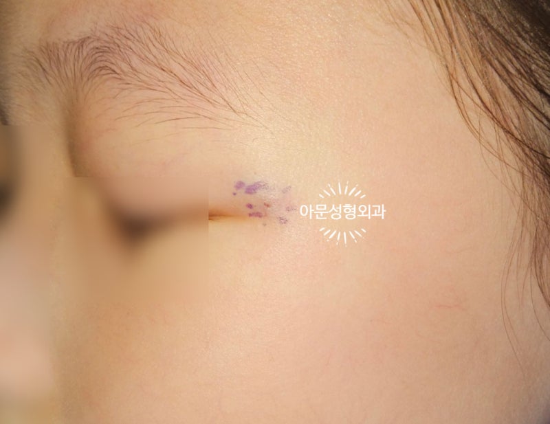 아기 낭종, 수면마취 수술시 주의점은? (서울 강동구 아문성형외과) 소아 피지낭종 표피낭종 ....