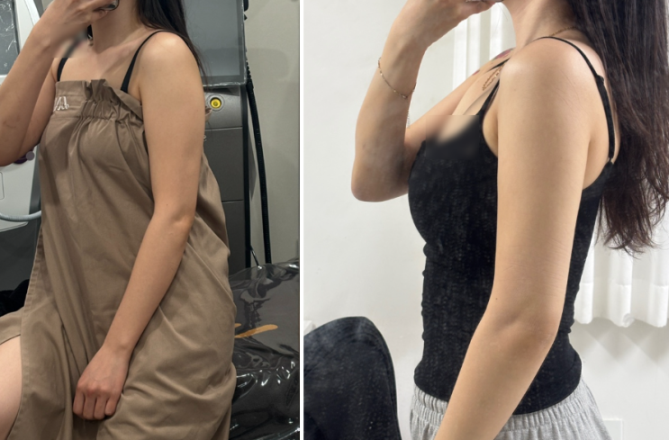  청담 피부과 팔 온다 예신관리, 결혼 준비 아니어도 추천하고 싶은 바디라인 후기