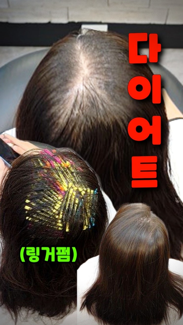  모류교정 링거펌으로 다이어트 탈모 해결｜대전에서 수원까지 찾는 이유