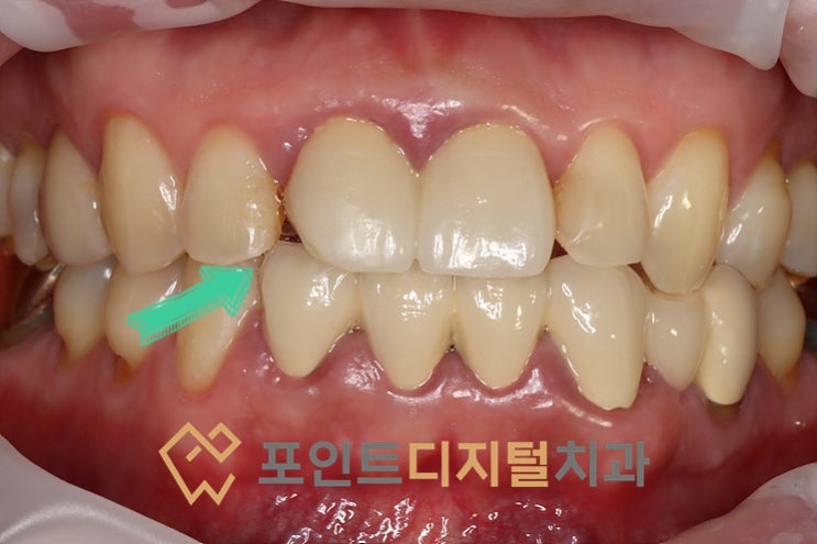 [탕정치과]  앞니 보철물 포셀린 파절, 크라운 재치료 전 레진 리페어로 해결해보기 / 천안 아산
