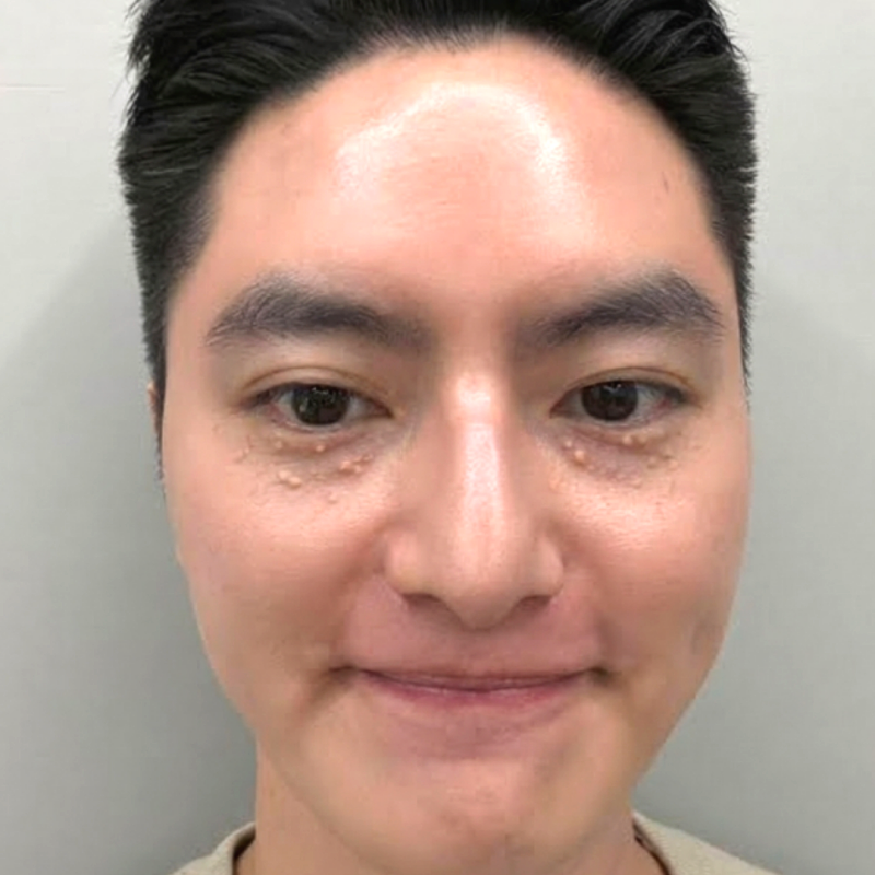 천안한관종 비립종 편평사마귀 구분법 정리