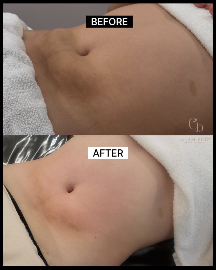  바이오본드 고주파 관리로 단단함 풀면 생기는 변화