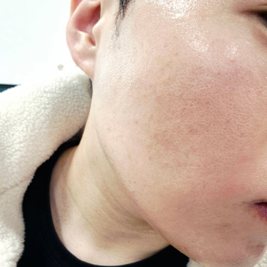  [내돈내산] 리쥬란+스킨보톡스 광명 찾은 후기. 가격부터 통증까지 솔직하게 (리쥬톡스, 리쥬톡톡)