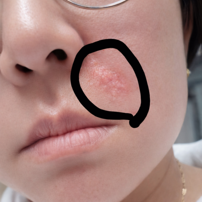 얼굴 대상포진 의심 증상 40대 엄마 리얼 후기 (초기증상 꼭 보세요)