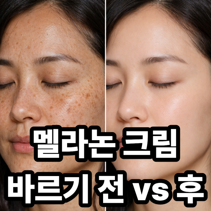  멜라논크림 사용 전후 비교, 실제 효과는 어느 정도일까?