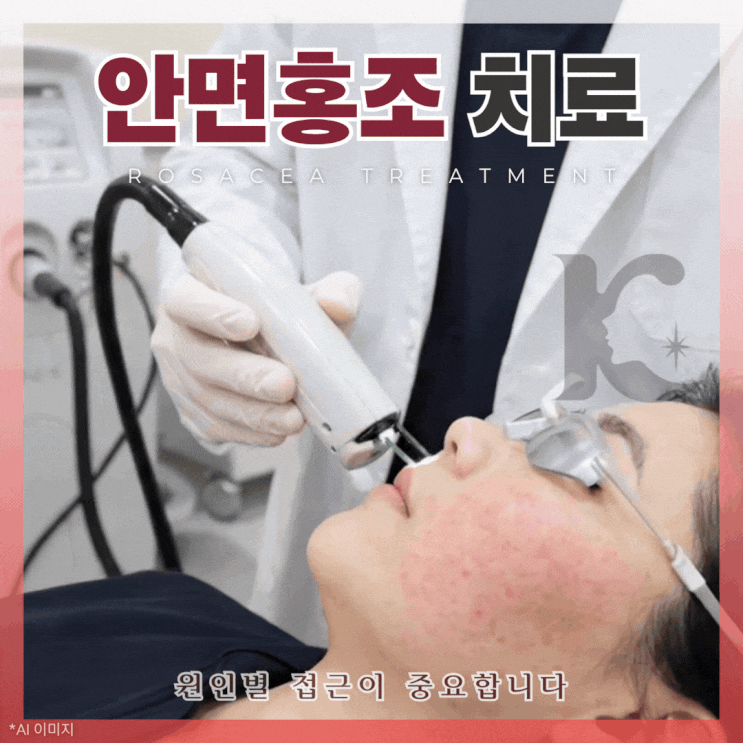  광주안면홍조 치료 브이빔 퍼펙타 원리 및 혈관레이저 후 주의사항에 대해