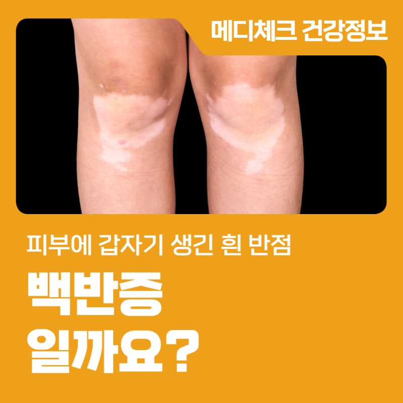 피부에 갑자기 생긴 흰 반점, 백반증일까요?