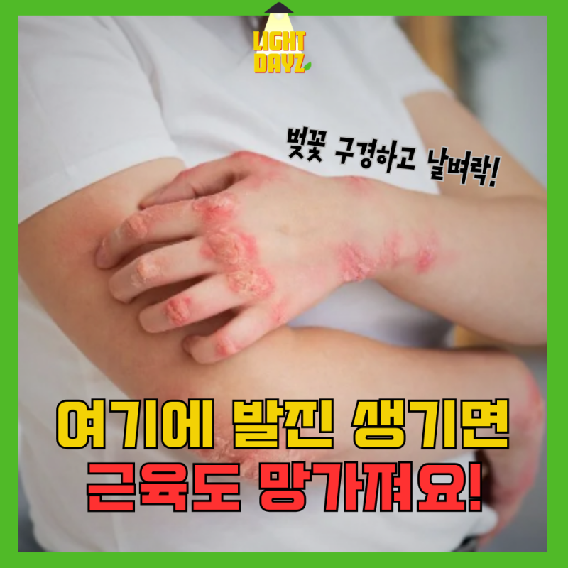 햇빛알러지 vs 피부근염, 초기증상 하나로 갈립니다! 구별법으로 체크하세요