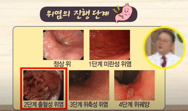 미란성위염 증상과 원인 치료방법 총정리