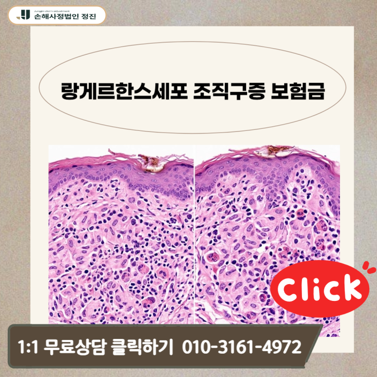  랑게르한스세포 조직구증 보험금, C96.6 진단비 거절을 이겨내는 손해사정 전략
