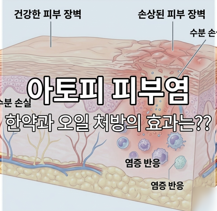  4세 영유아 아토피 한약 분당 한의원 치료의 예후는 ?