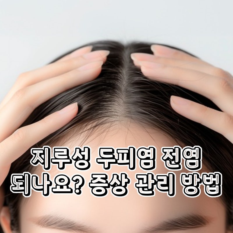 지루성 두피염 전염 되나요 증상과 관리 방법