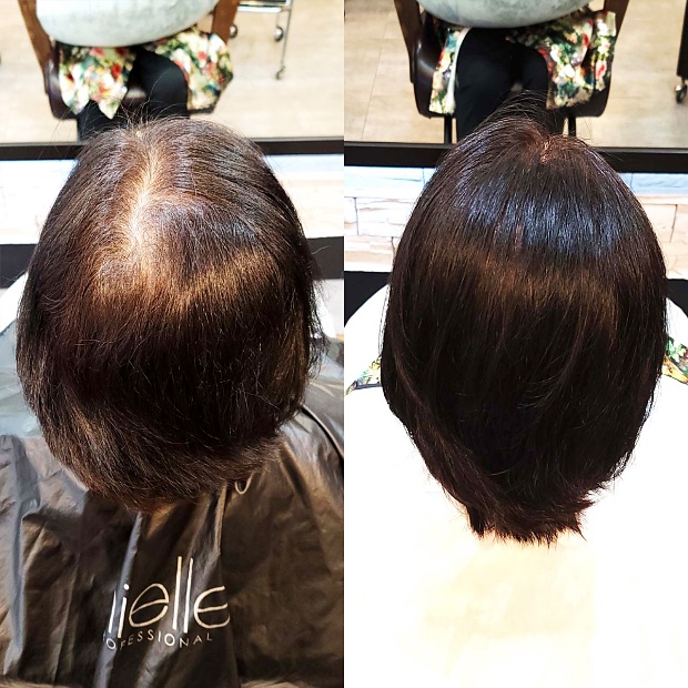  인천 링거펌 찾는 50대 여성 필독! 정수리 가르마 갈라짐과 휑한 머릿속, 모류교정으로 채워질까요?