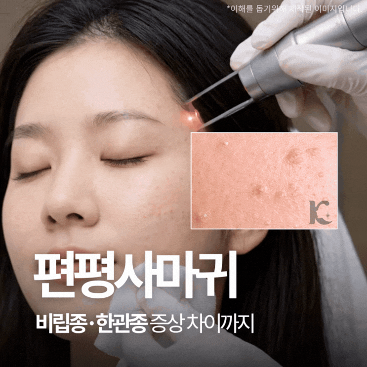  광주편평사마귀 증상과 레이저 치료, 제거 관리 방법? 비립종 한관종 차이점까지