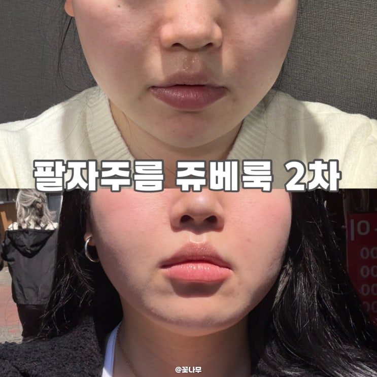  팔자주름 미감 좋은 강남쥬베룩 2차 콜라겐주사 후기