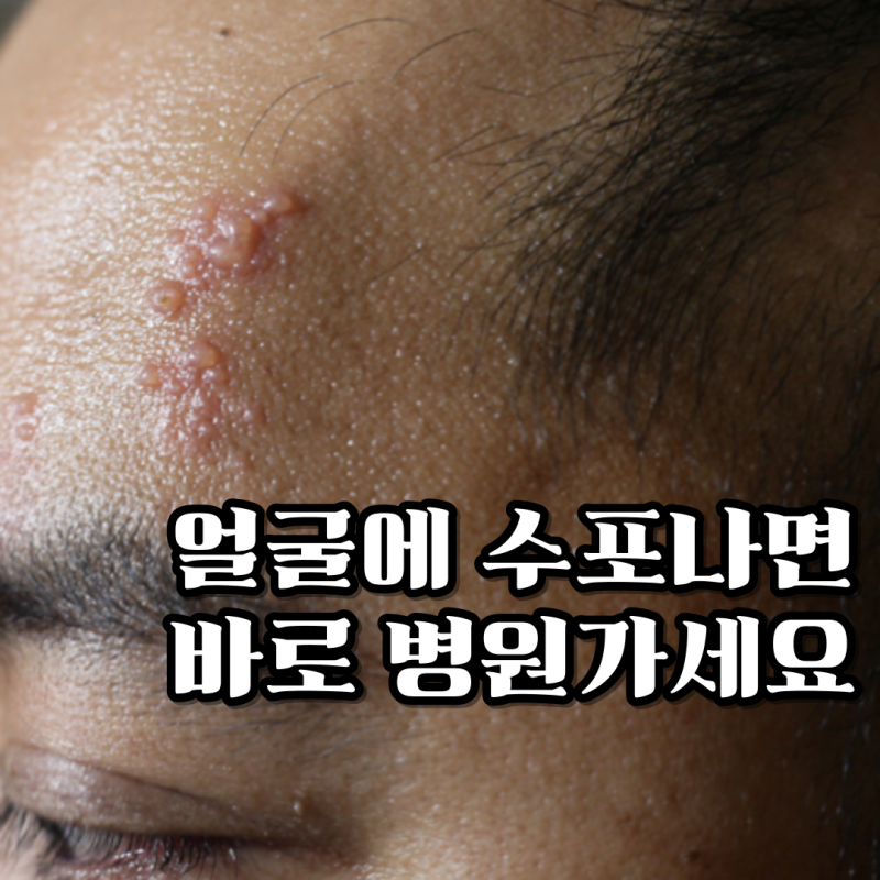 얼굴 대상포진 위험한 이유 실명 안면마비까지