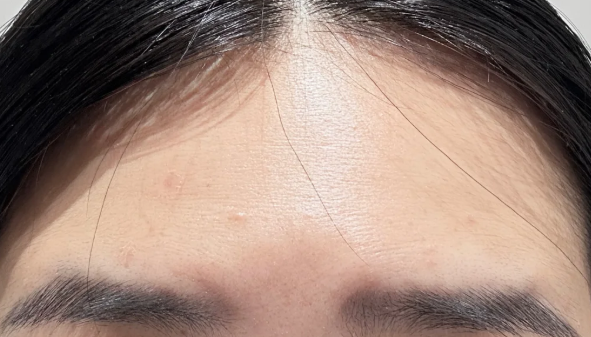  이마주름패치 고민하다 찾은 답